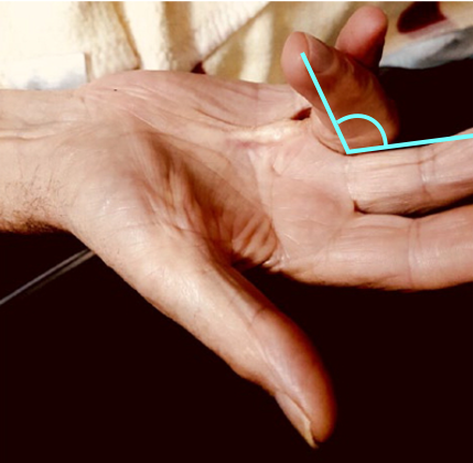 Bilden visar ett foto på kontraktur i MCP-led med sträckdefekt > 30°. Turkos illustration i bilden visar hur graden av kontrakturen mäts.